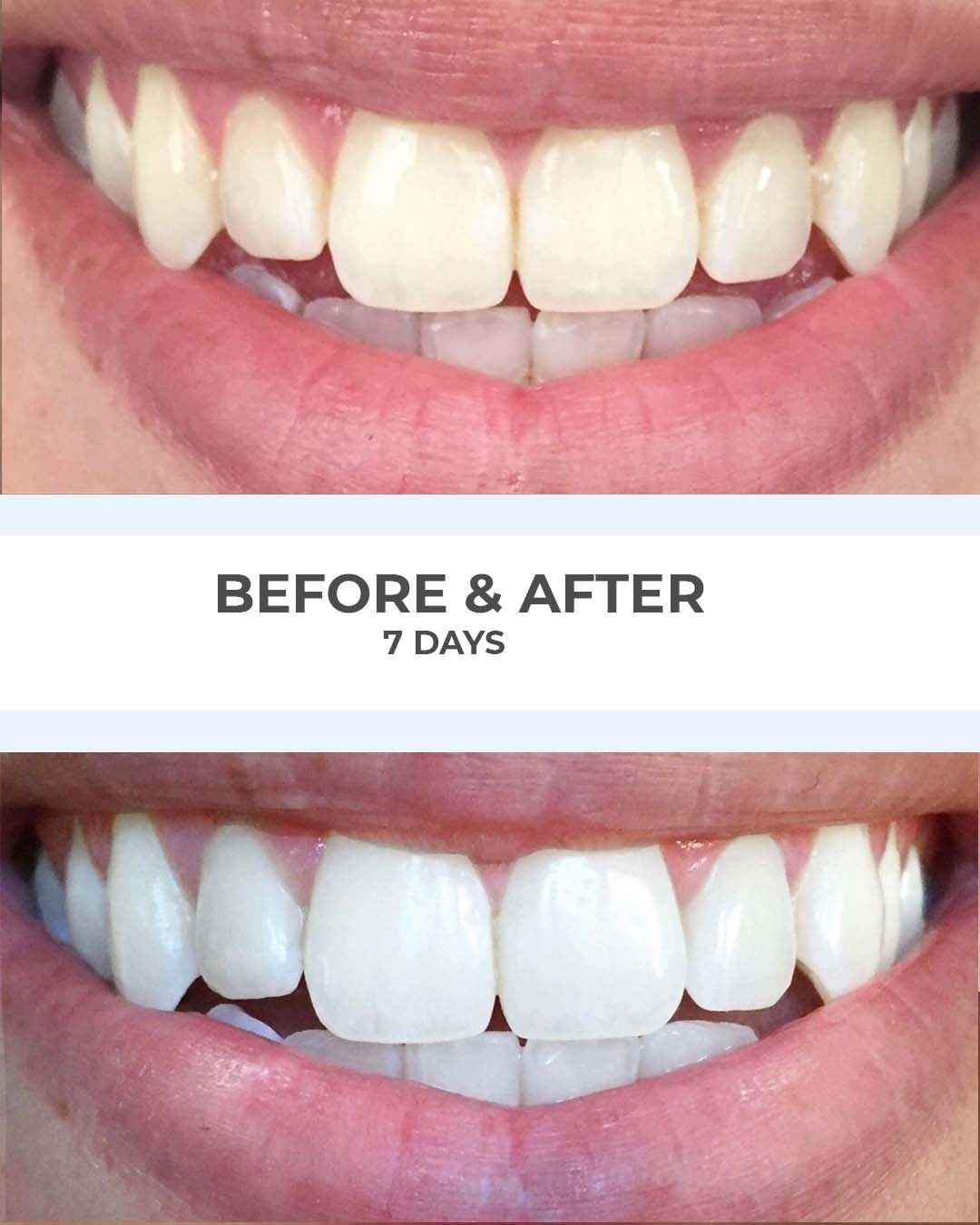 SmilePro before and after results